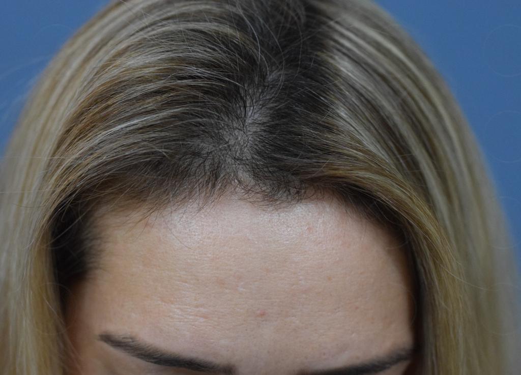 קורונה ורפואת עור: על נשירת שיער